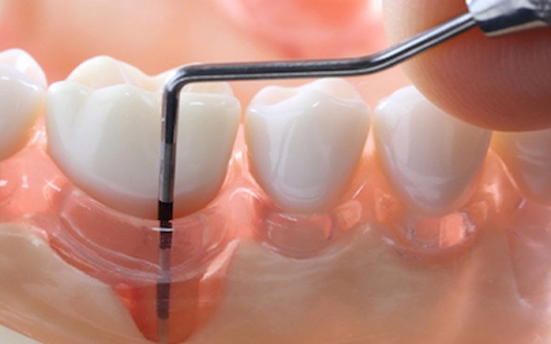 Periodontal
