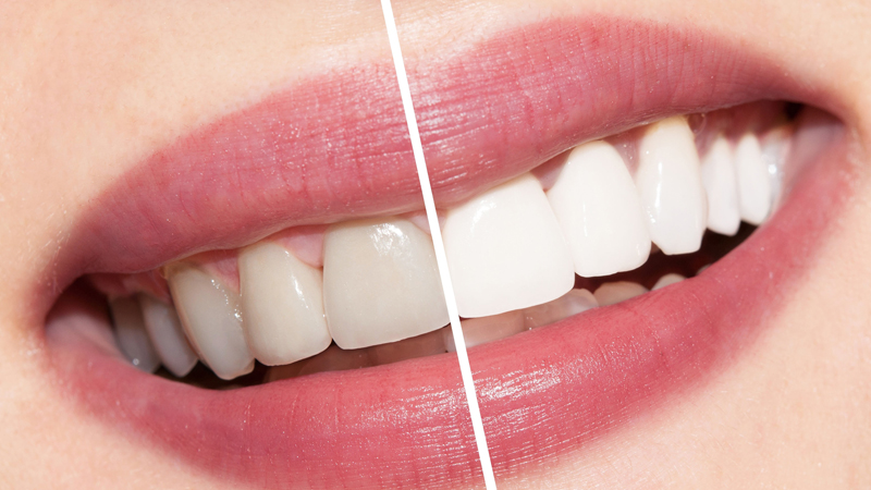 Teeth White