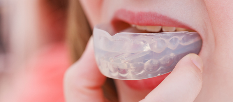 mouth guards