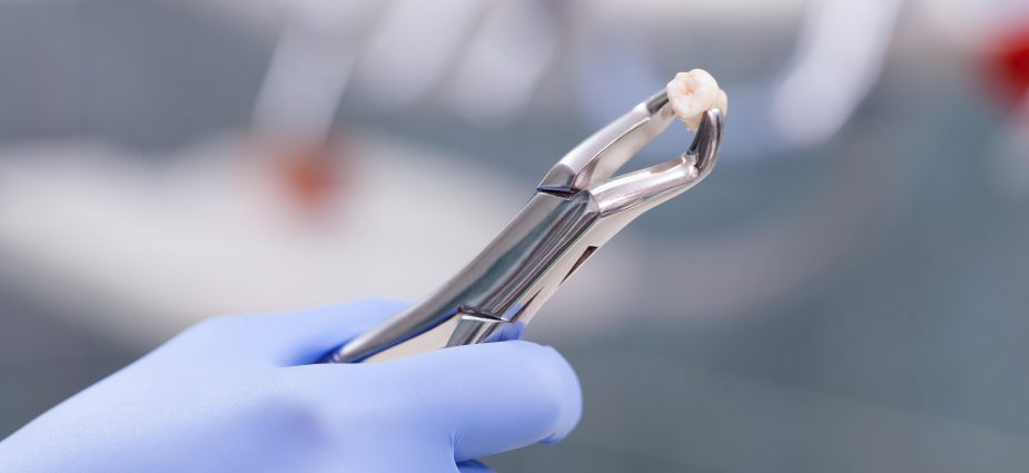 tooth-extraction